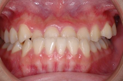 7 typov úsmevov, ktoré ľahko zachráni zubný strojček INVISALIGN. Ktorý je ten váš? 