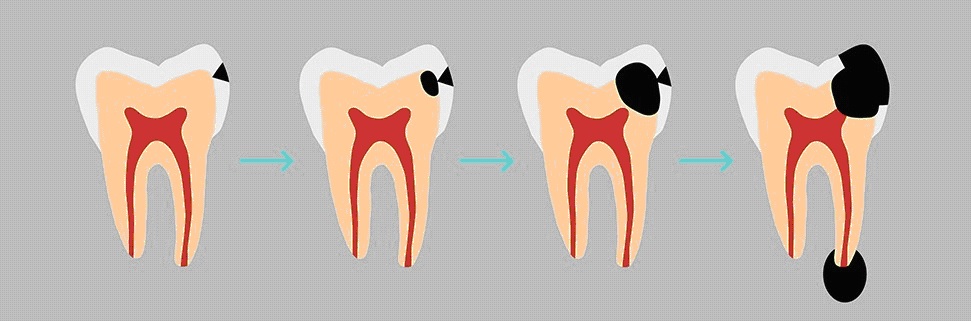 3 dôvody prečo ísť na preventívnu prehliadku k zubárovi
