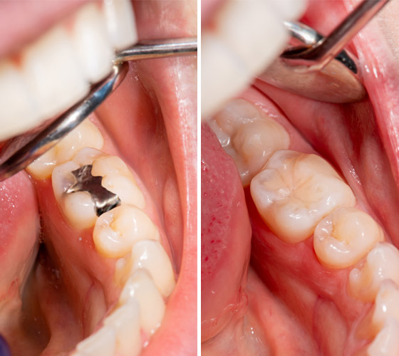 Záchovná stomatológia